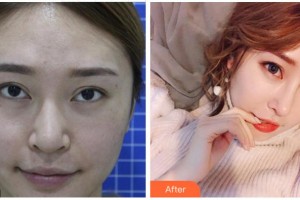 宜賓市第一人民醫(yī)院整形燒傷科毛波整形價(jià)格表附鼻部綜合案例展示