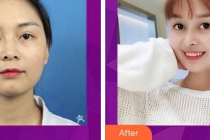 宜賓市第一人民醫(yī)院整形燒傷科陳國雙整形價(jià)格表附鼻部綜合案例展示