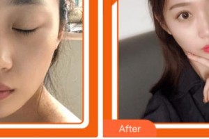 宜賓華仁醫(yī)學(xué)整形美容醫(yī)院汪成整形價(jià)格表附鼻部綜合案例展示