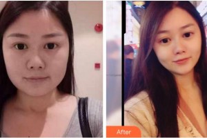 宜賓華仁醫(yī)學(xué)整形美容醫(yī)院鐘華華整形價(jià)格表附抗衰案例展示