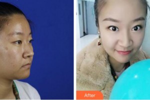 宜賓愛爾優(yōu)視眼科醫(yī)院徐文烽整形價(jià)格表附眼部綜合案例展示