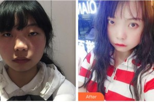 宜賓愛爾優(yōu)視眼科醫(yī)院王朝瑜整形價(jià)格表附切開雙眼皮案例展示