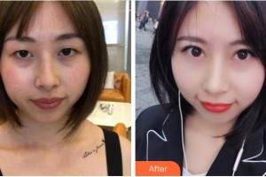 宜賓愛爾優(yōu)視眼科醫(yī)院陳龍華整形價(jià)格表附切開雙眼皮案例展示