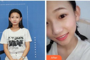 宜賓愛爾優(yōu)視眼科醫(yī)院李娜整形價(jià)格表附眼部綜合案例展示