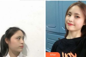 宜賓曼薇醫(yī)學(xué)整形醫(yī)院鄒勇整形價(jià)格表附切開雙眼皮案例展示