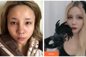 宜賓曼薇醫(yī)學(xué)整形醫(yī)院陳誠整形價(jià)格表附眼部綜合案例展示