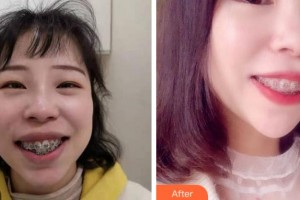 宜賓口腔醫(yī)院何明第整形價格表附金屬托槽矯正案例展示