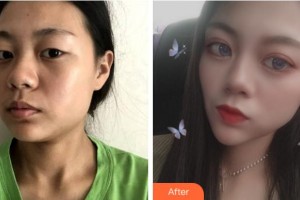 達(dá)州仁美醫(yī)學(xué)整形美容門診部周奇濤整形價格表附眼部綜合案例展示