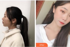 達(dá)州市中心醫(yī)院醫(yī)學(xué)美容中心李磊整形價格表附光子嫩膚案例展示