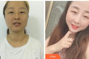 達(dá)州喬妍醫(yī)療美容診所尹秀山整形價格表附白瓷娃娃案例展示