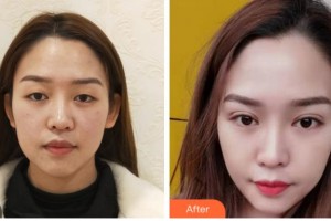 達(dá)州愛爾博視醫(yī)院鄒林整形價格表附眶隔脂肪釋放案例展示