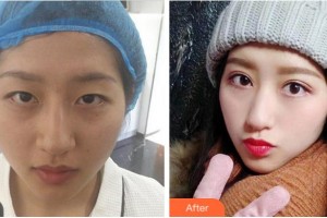 達(dá)州愛爾博視醫(yī)院周奇志整形價格表附眼部綜合案例展示