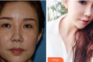 達(dá)州愛爾博視醫(yī)院許龍華整形價格表附外切祛眼袋案例展示