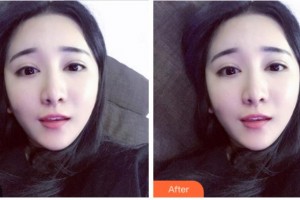 達(dá)州愛瑞眼科醫(yī)院匡毅整形價格表附上眼瞼去脂案例展示