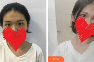 達(dá)州市中西醫(yī)結(jié)合醫(yī)院眼科劉進(jìn)整形價格表附切開雙眼皮案例展示