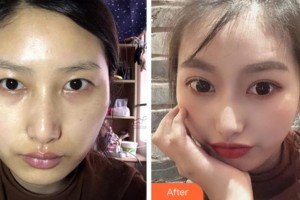 達(dá)州市中西醫(yī)結(jié)合醫(yī)院眼科王斌整形價格表附切開雙眼皮案例展示