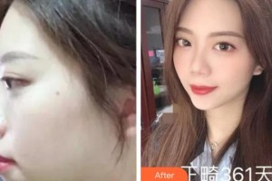 雅安鑫西華口腔整形醫(yī)院劉國敏整形價格表附金屬托槽矯正案例展示