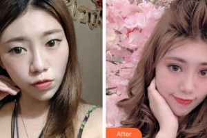 巴中依韓（原雙均）醫(yī)療美容診所張永茂整形價格表附眼部綜合案例展示