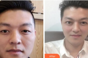 巴中時光醫(yī)學(xué)美容門診部李洪強(qiáng)整形價格表附切開雙眼皮案例展示