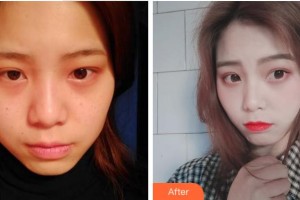 資陽麗人醫(yī)療美容門診部黃衛(wèi)紅整形價格表附激光祛斑案例展示