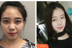 資陽伊之美整形美容醫(yī)院李正勇整形價格表附鼻部綜合案例展示