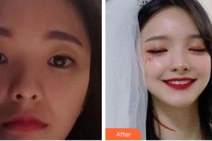 資陽伊之美整形美容醫(yī)院鄒家旋整形價格表附美白導(dǎo)入案例展示