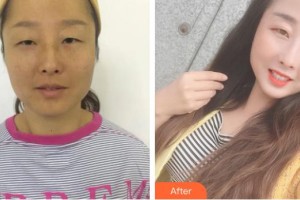 資陽市中醫(yī)醫(yī)院眼科楊建芳整形價格表附內(nèi)切祛眼袋案例展示