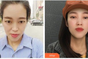 資陽維多利亞醫(yī)療美容醫(yī)院黃國強(qiáng)整形價格表附切開雙眼皮案例展示