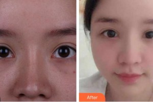 資陽市中醫(yī)醫(yī)院眼科王耀住院醫(yī)師整形價格表附眼部修復(fù)案例展示