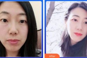 資陽市中醫(yī)醫(yī)院眼科黃緒清整形價格表附切開雙眼皮案例展示