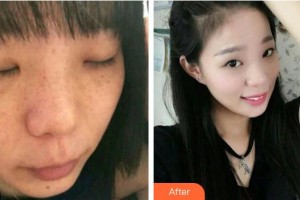 涼山愛麗諾整形美容醫(yī)院聶立敏整形價格表附清潔祛痘案例展示