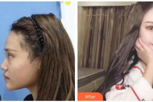 涼山愛麗諾整形美容醫(yī)院涂文浩整形價格表附鼻部綜合案例展示