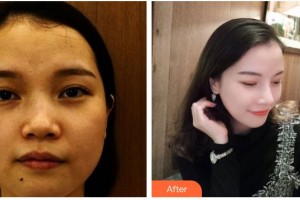 涼山彝族自治州第一人民醫(yī)院燒傷整形科殷秀清整形價格表附鼻部綜合案例展示