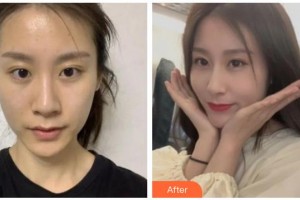 涼山愛爾眼科醫(yī)院肖玲整形價格表附切開雙眼皮案例展示