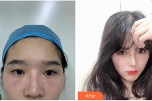 涼山愛爾眼科醫(yī)院黃應(yīng)祥整形價格表附眼部修復(fù)案例展示