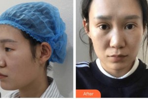 涼山愛爾眼科醫(yī)院吉江峰整形價格表附眼部綜合案例展示