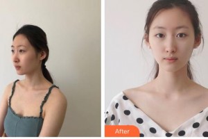 涼山彝族自治州第二人民醫(yī)院燒傷整形外科葉一整形價格表附光子嫩膚案例展示