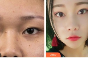 涼山州中西醫(yī)結(jié)合醫(yī)院眼科張薇整形價格表附切開雙眼皮案例展示