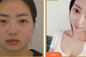 涼山州中西醫(yī)結(jié)合醫(yī)院眼科李琪整形價格表附眼部綜合案例展示