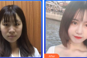 佛山華美整形美容醫(yī)院夏相員整形價(jià)格表附眼部綜合案例展示