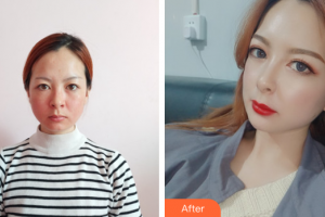 佛山廣美醫(yī)療美容門(mén)診部孫凱整形價(jià)格表附熱瑪吉案例展示