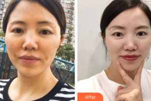 佛山顏植醫(yī)療美容門(mén)診部李莉整形價(jià)格表附埋線提升案例展示