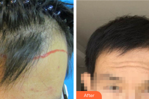 佛山市中醫(yī)院皮膚科鐘衛(wèi)紅整形價(jià)格表附種植發(fā)際線案例展示