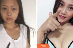 佛山華美整形美容醫(yī)院陳聽(tīng)柿整形價(jià)格表附假體隆胸案例展示