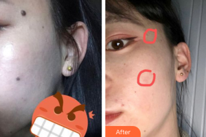 佛山市中醫(yī)院皮膚科莫惠芳整形價(jià)格表附祛痣案例展示