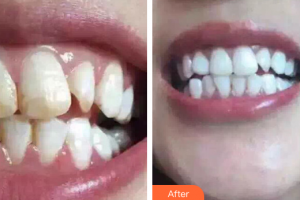 佛山中大口腔醫(yī)院羅明軒整形價(jià)格表附皓齒美白案例展示