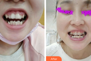 佛山中大口腔醫(yī)院陳文杰整形價(jià)格表附牙齒陶瓷矯正案例展示