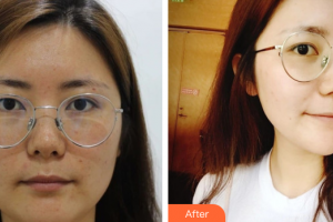 佛山黛顏人醫(yī)療美容門(mén)診部李忠隨整形價(jià)格表附面部吸脂案例展示