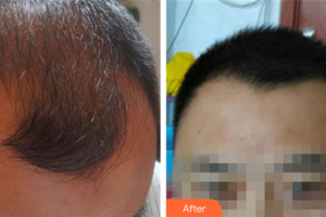 佛山廣文皮膚科醫(yī)院邱群英整形價(jià)格表附種植發(fā)際線案例展示