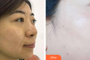 佛山華美整形美容醫(yī)院羅宇康整形價(jià)格表附BBL祛斑案例展示